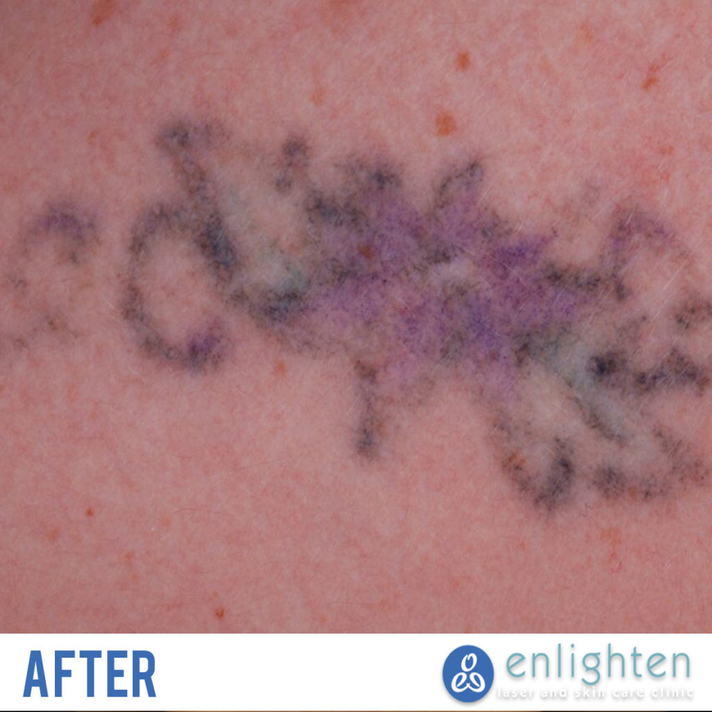 picoway laser tattoo removal after photo