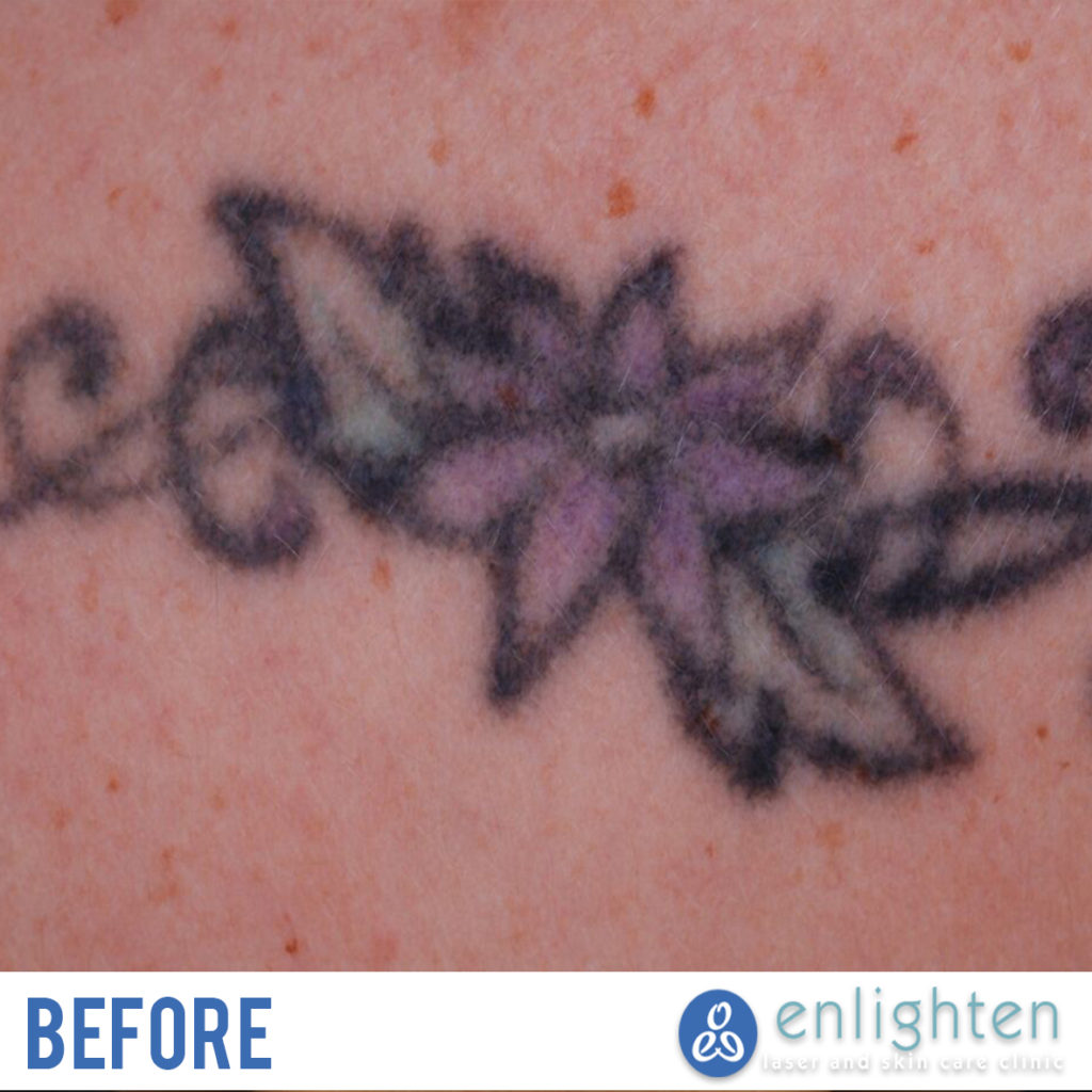 picoway laser tattoo removal before photo