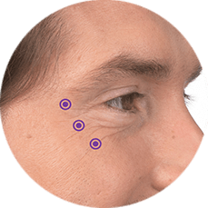 crowsfeet botox for men calgary