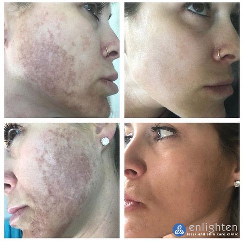 Say Goodbye To Sun Damage | Enlighten Laser and Skin Care Clinic