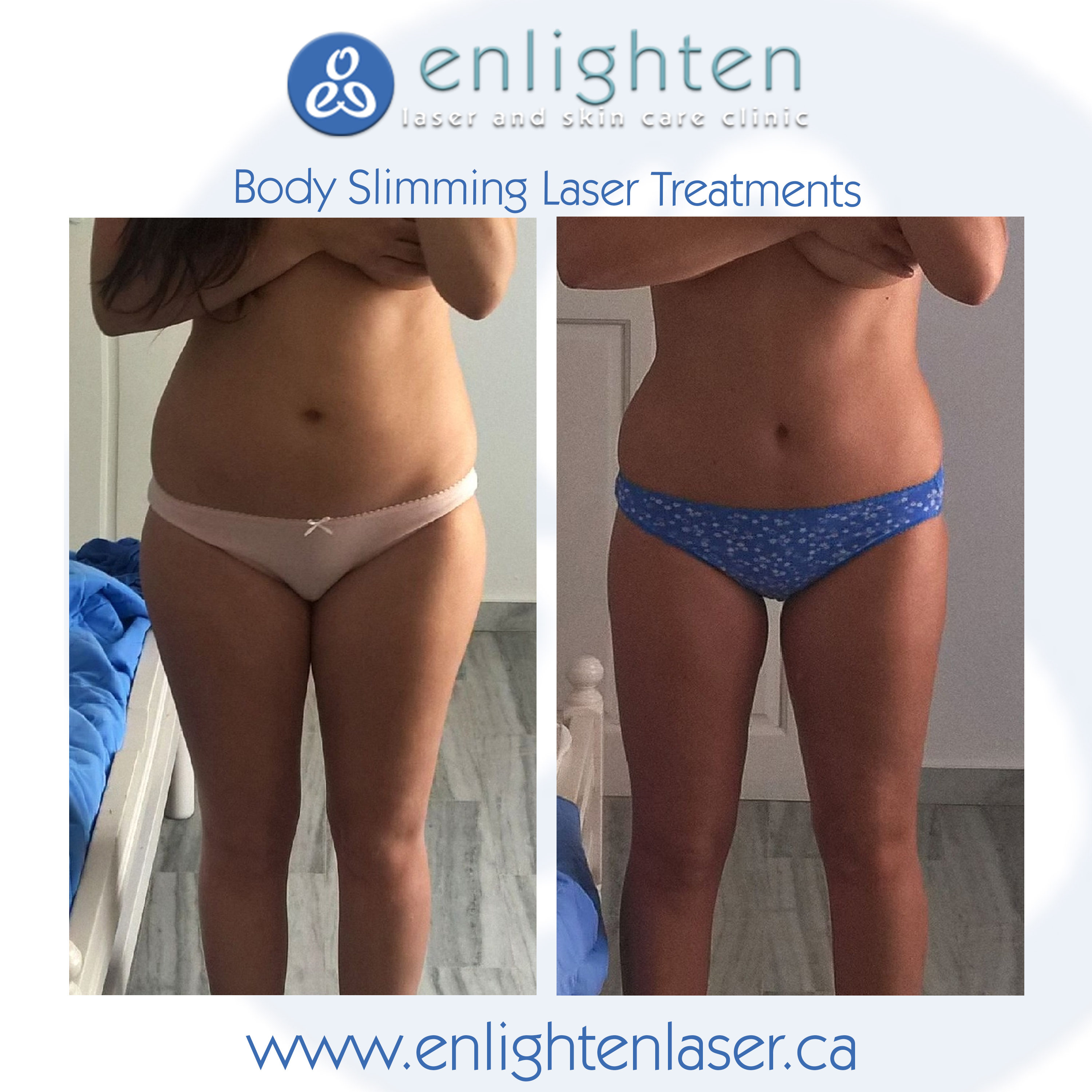 Body Slimming: What is it anyway?  Enlighten Laser and Skin Care Clinic