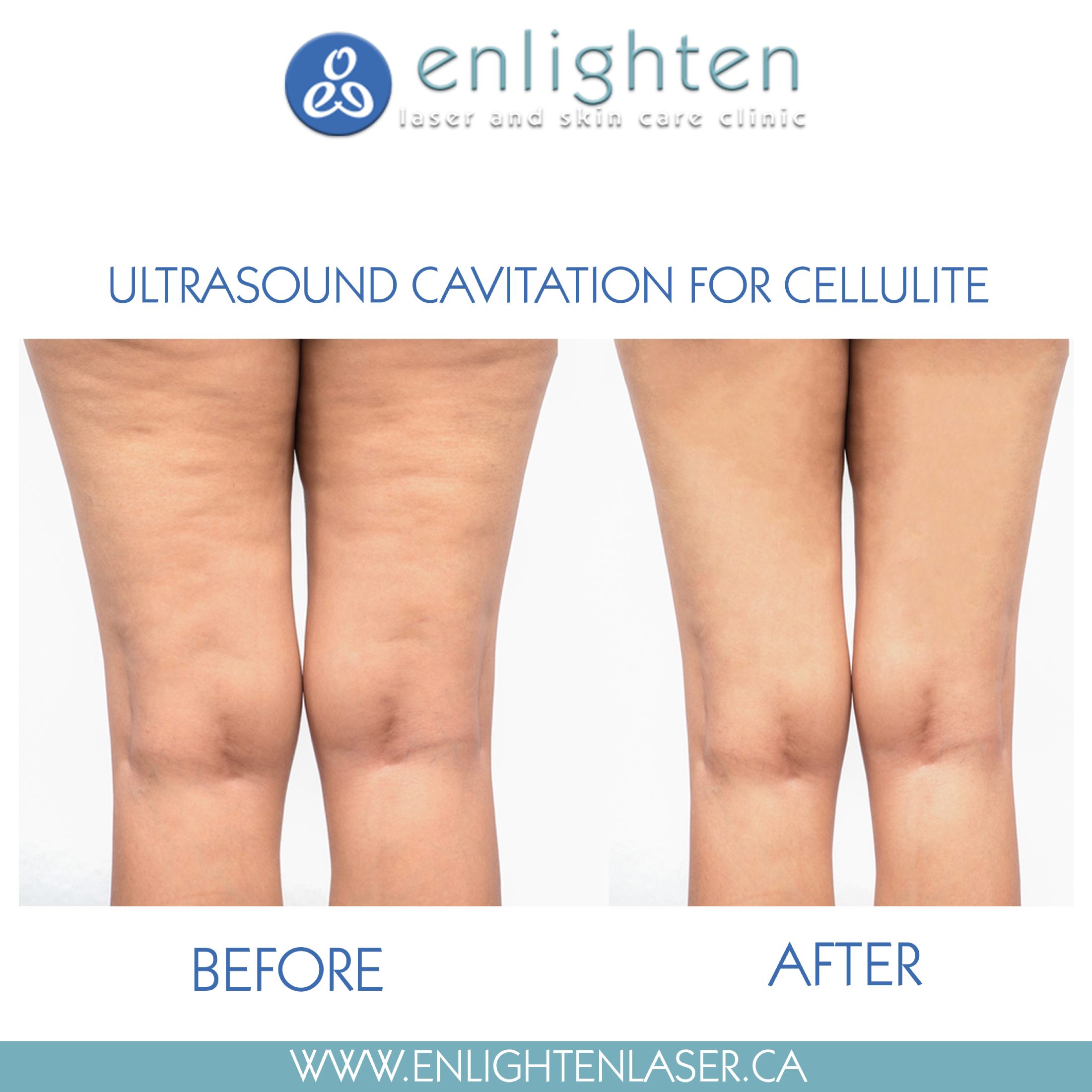 Ultrasound Cavitation, Cellulite Reduction