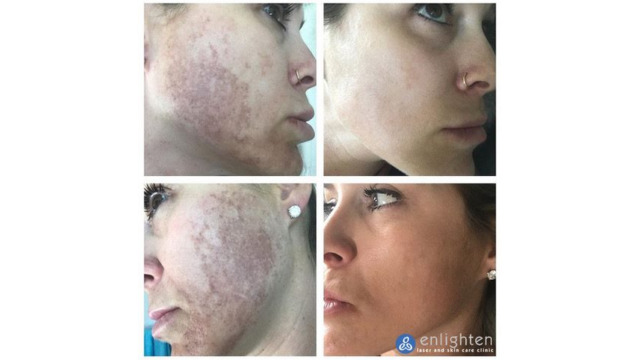 Enlighten laser and skin care clinic - IPL Photorejuvenation - before and after results