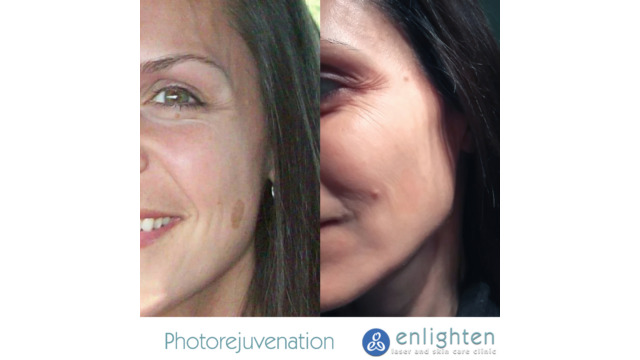 Enlighten laser and skin care clinic - IPL Photorejuvenation - before and after results
