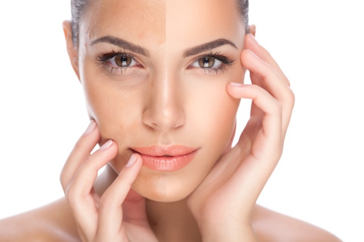 Sublative Skin Resurfacing Skin Treatment 