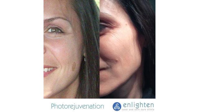 Enlighten laser and skin care clinic - IPL Photorejuvenation - before and after results