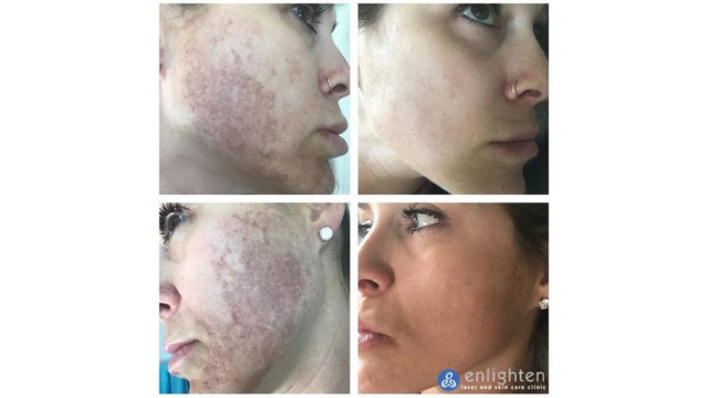 Enlighten laser and skin care clinic - IPL Photorejuvenation - before and after results