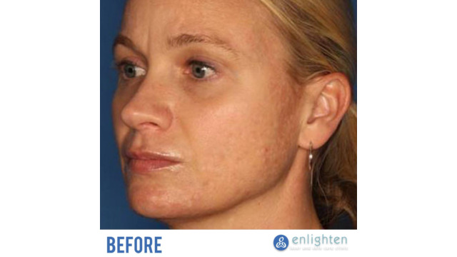 Enlighten laser and skin care clinic - IPL Photorejuvenation - before and after results