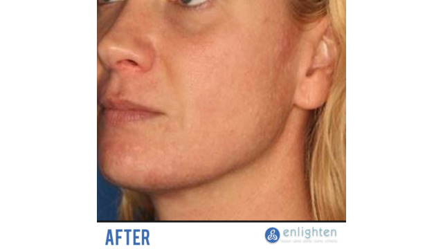 Enlighten laser and skin care clinic - IPL Photorejuvenation - before and after results