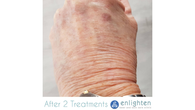Enlighten laser and skin care clinic - IPL Photorejuvenation - before and after results