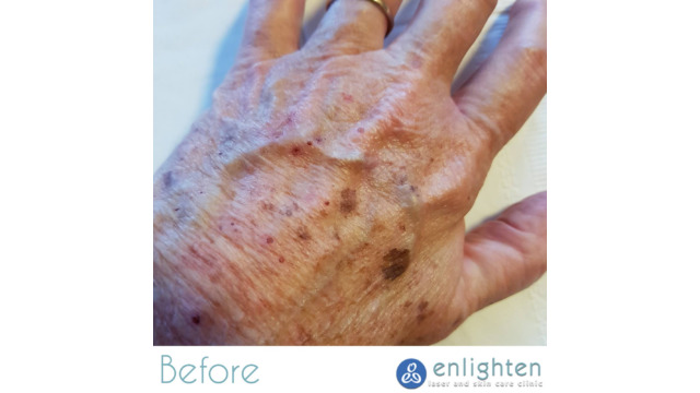 Enlighten laser and skin care clinic - IPL Photorejuvenation - before and after results