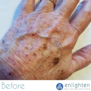 Enlighten laser and skin care clinic - IPL Photorejuvenation - before and after results