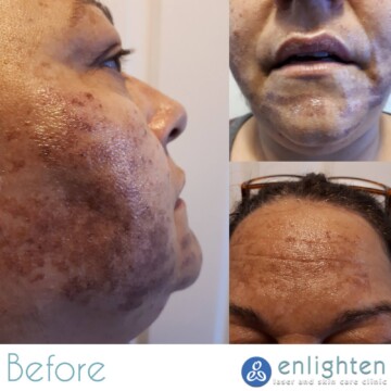 Enlighten laser and skin care clinic - IPL Photorejuvenation - before and after results