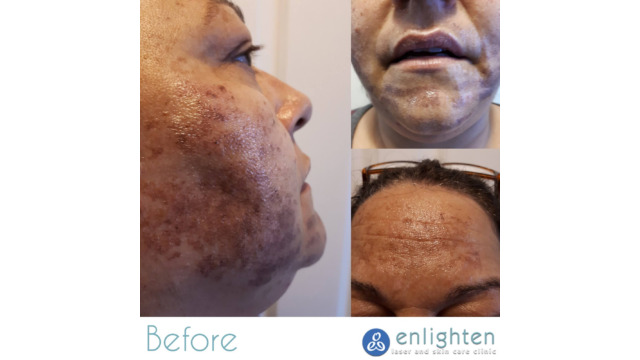 Enlighten laser and skin care clinic - IPL Photorejuvenation - before and after results