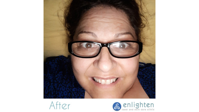 Enlighten laser and skin care clinic - IPL Photorejuvenation - before and after results